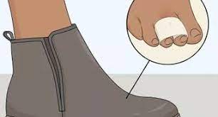 So does that mean the *same* steristrips stay on that whole time? Steri Strips Entfernen 9 Schritte Mit Bildern Wikihow