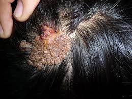 A nevus formed by an aggregate of sebaceous glands. Nevus Sebaceus Article