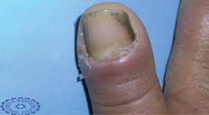 Pulpy kidney disease is a disease caused by clostridium perferingens type d, occurs in sheep worldwide. Nail Disorders In Patients With Chronic Renal Failure
