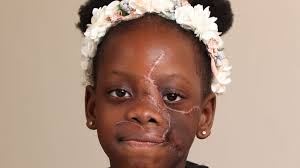 My little girl, 6, was mauled by pet Bully that ripped half her face to  shreds : r/BanPitBulls