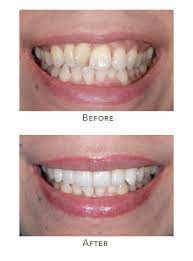 Another way to manage crooked teeth esthetically would be with composite bonding or porcelain veneers. How To Get Straight Teeth Quickly Crooked Front Teeth Solutions