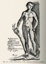 It is a disorder arising due to pellagra symptoms. History Of Pellagra Libraries Uab