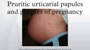 Image result for pruritic urticarial papules and plaques of pregnancy