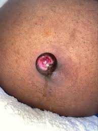 Image result for Umbilicus botryoides