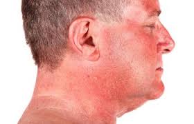 🥇 Treating Allergic Reactions to Posion Ivy