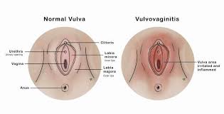 Image result for Vulvitis