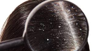 See full list on verywellhealth.com How Do I Know If I Have A Dry Scalp Sensitive Skin Dandruff Or Seborrheic Dermatitis Pharmaceutical Specialties Inc