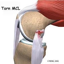 Moderate sprain with some ligaments torn. Recovery From An Mcl Injury Howard J Luks Md