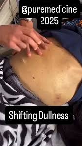 Image result for Shifting Dullness Test