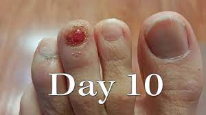 In the meantime, your child can. Toenail Injury Time Lapse Regrowth Youtube
