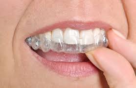 Invisible braces is the common vernacular for what's really called clear aligners.. How Invisalign Works