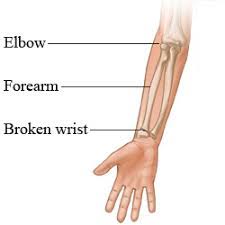 How to tell if your wrist is broken. Wrist Injury Treatment Bangalore India Fractures Around Wrist