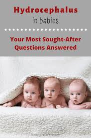 Hydrocephalus In Babies What You Need To Know Now This Or That Questions How Are You Feeling Baby