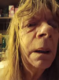 Hi all! I just wanted to introduce myself and share a photo I took. This is  me in a terrible way. Autoimmune flare up!