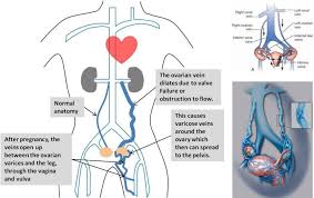 Pelvic Congestion Syndrome Pcs Www Drmareksepiolo Com