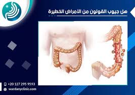 هل جيوب القولون من الأمراض الخطيرة لما يعد من أكثر التساؤلات شيوع ا