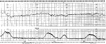 Image result for Late Deceleration