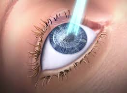 Excimer Lazer Goz Ameliyati Lazer Goz Ameliyati Excimer Laser Eskisehir Lazer Eskisehir Lazer Epilasyon