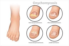 Image result for Onycholysis feet