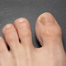 Image result for onychomycosis