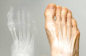 Image result for Hallux Varus