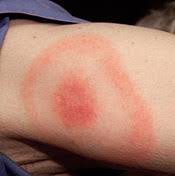 La piqûre s'accompagne d'un gonflement de quelques. Piqures D Insectes Chez L Enfant Prevenir Et Traiter