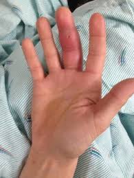 People who are septic are in a state. Kanavel Signs Of Flexor Sheath Infection A Cautionary Tale British Journal Of General Practice