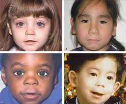 Palpebral Fissure Science Over A Cuppa