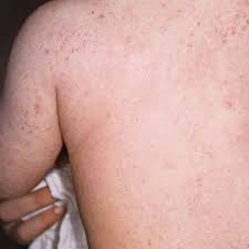 How To Recognize And Treat Infant Eczema Atopic Dermatitis Baby Eczema Red Bumps On Baby Baby Cheeks