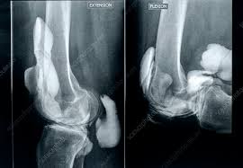 Image result for Knee XRay