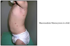 Image result for Urticaria pigmentosa children