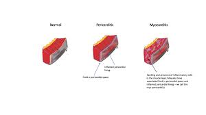 Myocarditis, also known as inflammatory cardiomyopathy, is inflammation of the heart muscle. Learning More About Myocarditis And Pericarditis Asian Heart Vascular Centre Ahvc