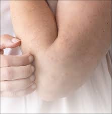 ควรระวัง! ร่างกายมีอาการคัน 2 ส่วนนี้ อาจเป็นสัญญาณของ "มะเร็งตับ" ไม่ใช่อาการแพ้