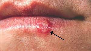If you have a blemish in the middle of your lip, it's likely to be a cold sore. Cold Sore Vs Pimple Symptoms And Treatment