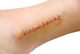 The cut is on the mouth, face, hand or genitals. Does Your Cut Need Stitches Complete Care