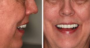 Novaloc: A First-Choice System for Overdentures