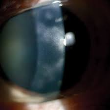 Where Do You Stand On These Refractive Surgery Controversies?