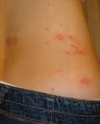 Farmacia Salus Dott Brignola P Iva 07453480639 Tel 081 775 28 02 Herpes Zoster 5 Cose Da Sapere Sul Fuoco Di Sant Antonio