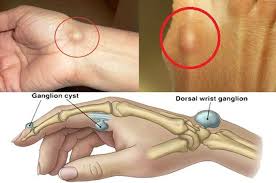 Apabila dengan tips di atas keluhan anda masih sering. Gejala Penyakit Kista Bisa Dideteksi Dari Benjolan Di Tangan Semua Halaman Nakita
