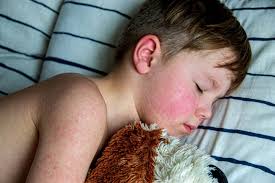Image result for Measles