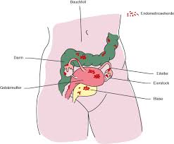 Es kann sehr schmerzhaft für die frau sein. Was Ist Endometriose Und Wie Gehe Ich Vor