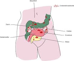 Das blut fließt allerdings nicht im normalen weg ab was zysten, verwachsungen, entzündungen und vernarbungen verursachen kann, die zu teils. Was Ist Endometriose Und Wie Gehe Ich Vor