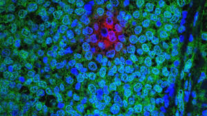 6 ﻿ radiation therapy may be recommended to slow the growth of these tumors and ease symptoms. Diverse Drug Resistant Cancer Cells Share A Hidden Weakness Ucsf Helen Diller Family Comprehensive Cancer Center