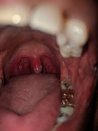 The term is a latin word that associated to large grape. Uvular Necrosis As A Cause Of Throat Discomfort After Endotracheal Intubation Bmj Case Reports