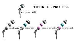 Tija femurala realizata din aliaj de titan prezinta o dubla acoperire a suprafetei: Tipurile De Proteze De Sold NecimentatÄƒ CimentatÄƒ CeramicÄƒ