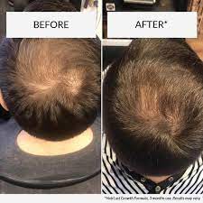 Nutrafol won the allure 2018 best of beauty breakthrough award. Hairlust Hair Growth Formula Tablets Hair Growth Vitamins For Men Hairlust Uk
