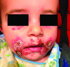 Spotted a rash on baby's skin? A 7 Month Old Male Presents With Perioral Rash And Fever Mdedge Pediatrics