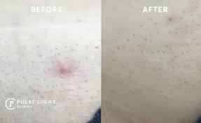 Maybe you would like to learn more about one of these? Brazilian Laser Hair Removal Pulse Light Clinic London