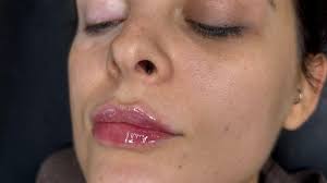 Best microneedling skin treatments near me in Stanley, Wakefield