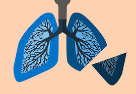 Some patients with lung cancer may feel a generalized ache throughout their back, while others will feel sharp, stabbing pains. Life After Lobectomy 6 Steps To A Smooth Recovery After Lung Cancer Surgery Health Essentials From Cleveland Clinic
